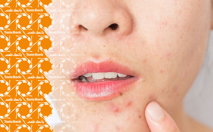 روش درمان جوش صورت